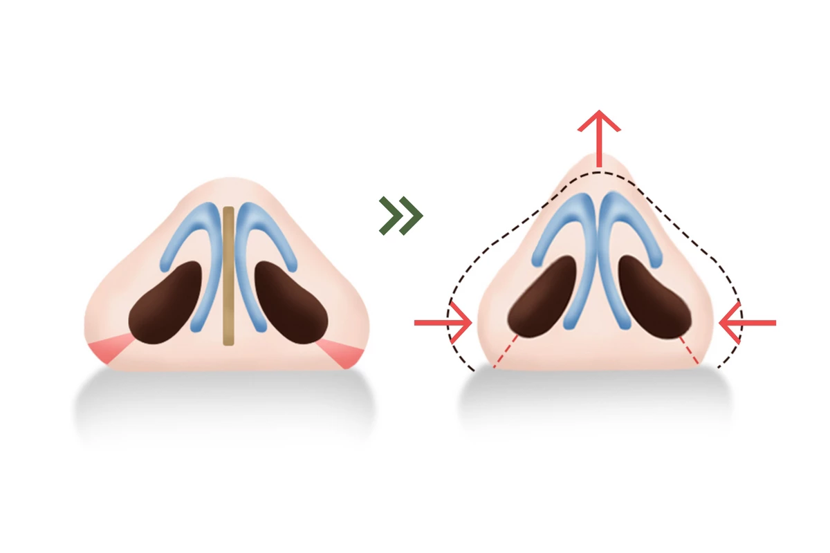 韓国の素晴らしい整形外科病院 小鼻縮小手術 小鼻を狭くする方法