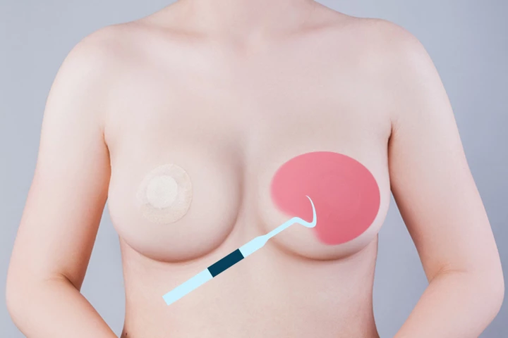 韩国精彩整形医院乳房假体取出手术方法步骤2