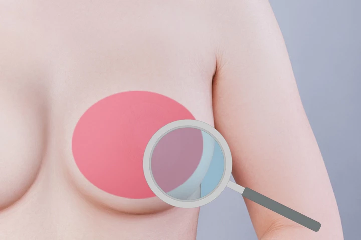 韩国精彩整形医院乳房假体取出手术方法第3步