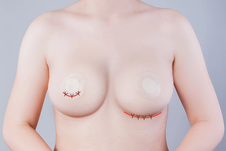 韩国精彩整形医院乳房假体取出手术方法第5步