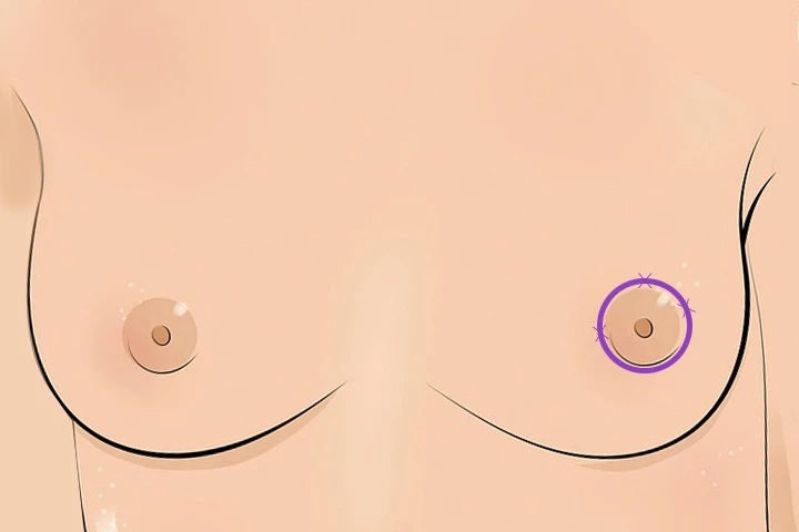 韩国精彩整形医院 乳房提升手术 乳晕切开术