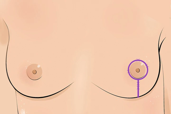 韩国精彩整形医院乳房提升手术垂直棒棒糖切口