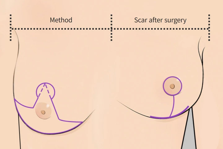 韓国の素晴らしい整形外科病院 乳房縮小アンカー形切開