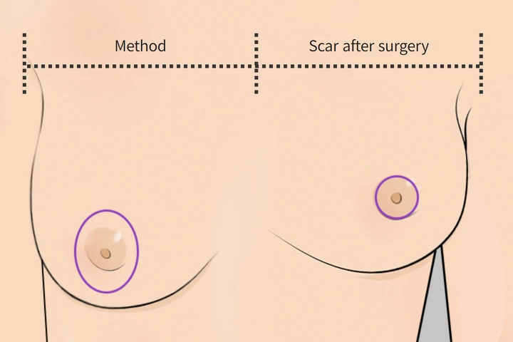 韓国の素晴らしい整形外科病院 乳房縮小 乳輪切開
