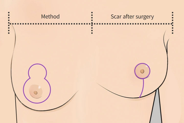韓国の素晴らしい整形外科病院 乳房縮小縦切開