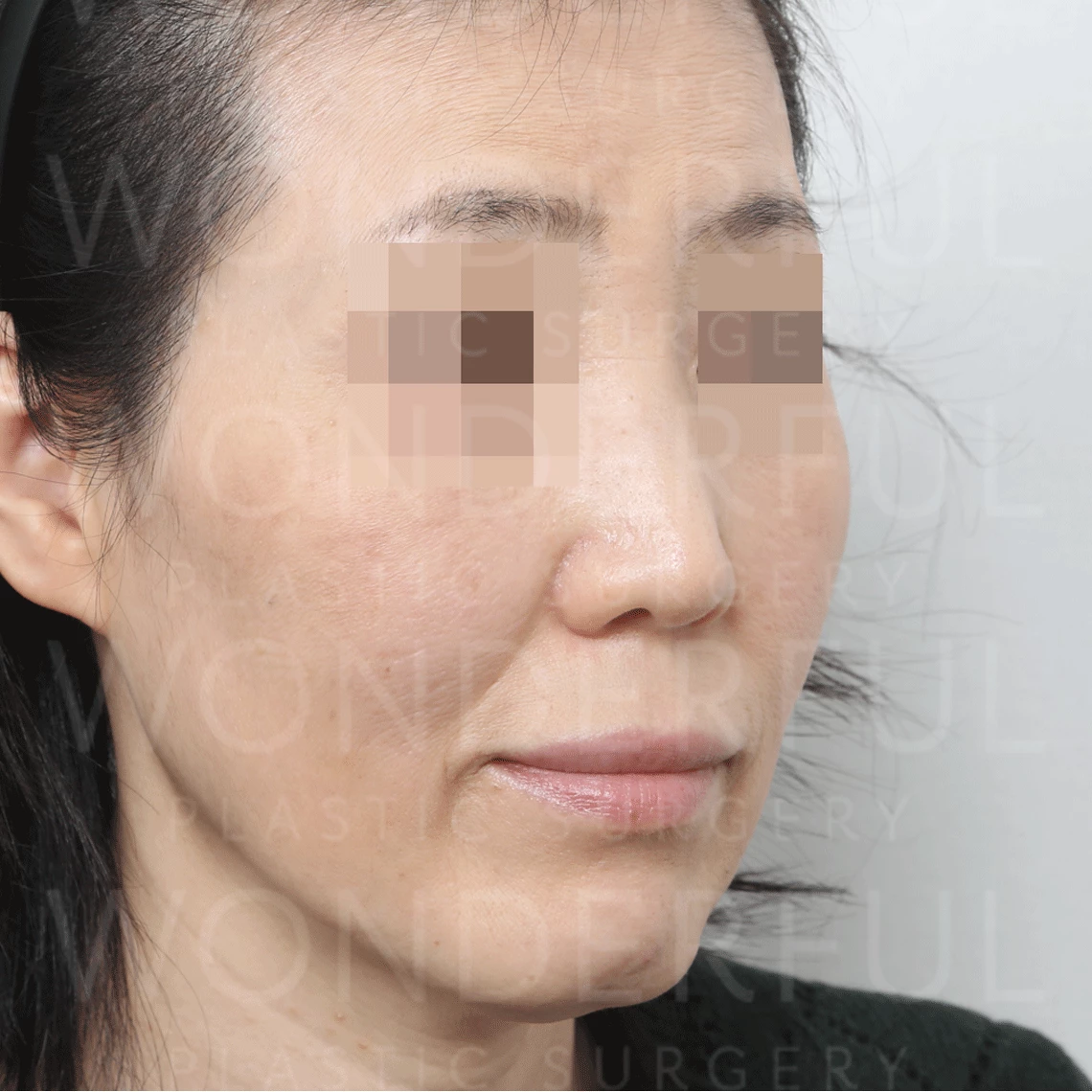 wonderful-plastic-surgery-hospital-in-korea-fat-grafting-before-after-results-after-1