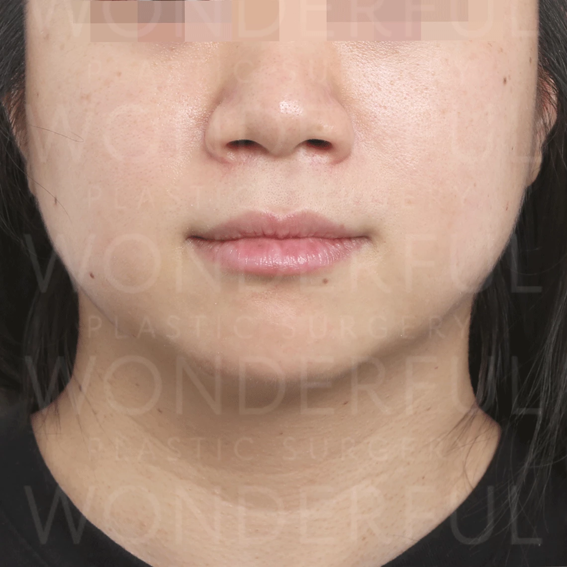 wonderful-plastic-surgery-hospital-in-korea-inmode-lifting-before-after-results-after-1