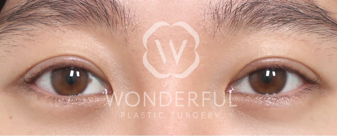 wonderful-plastic-surgery-hospital-in-korea-korean-premium-incision-double-eyelid-surgery-before-after-results-after-1