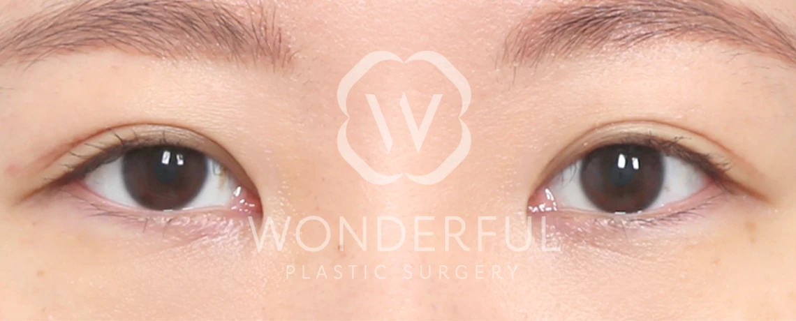 wonderful-plastic-surgery-hospital-in-korea-korean-premium-incision-double-eyelid-surgery-before-after-results-after-2