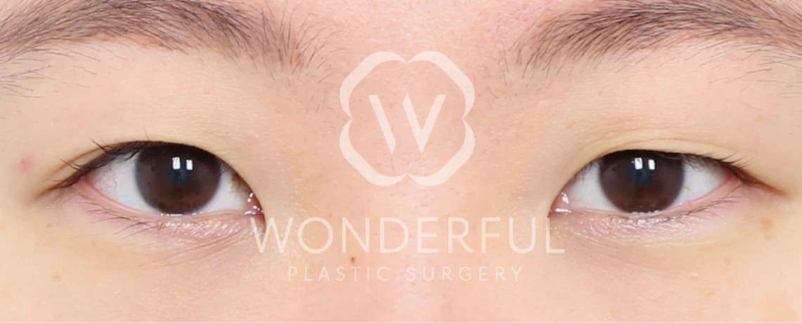 wonderful-plastic-surgery-hospital-in-korea-korean-premium-incision-double-eyelid-surgery-before-after-results-before-2