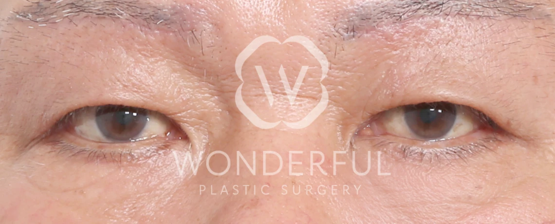 wonderful-plastic-surgery-hospital-in-korea-lower-blepharoplasty-before-after-results-after-1