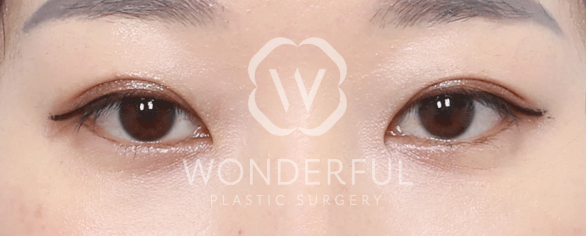 wonderful-plastic-surgery-hospital-in-korea-lower-eyelid-fat-repositioning-surgery-before-after-results-after-2