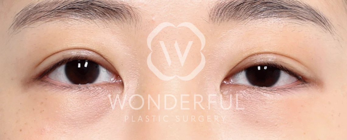 wonderful-plastic-surgery-hospital-in-korea-lower-eyelid-fat-repositioning-surgery-before-after-results-before-1