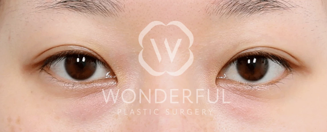 wonderful-plastic-surgery-hospital-in-korea-lower-eyelid-fat-repositioning-surgery-before-after-results-before-2