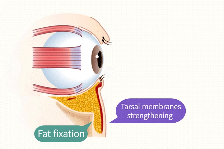 wonderful plastic surgery hospital in korea lower eyelid fat repositioning surgery method step 4