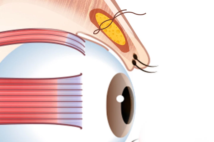 韓国の素晴らしい整形外科病院の非切開眼瞼下垂矯正手術方法ステップ3