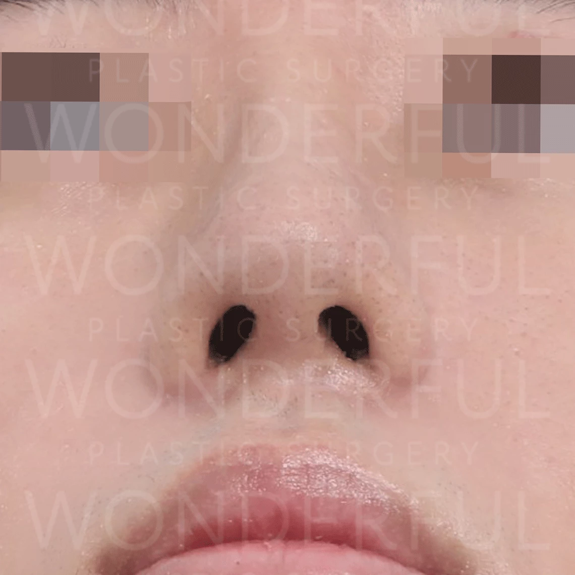 wonderful-plastic-surgery-hospital-in-korea-nostril-alar-reduction-surgery-before-after-results-after-1