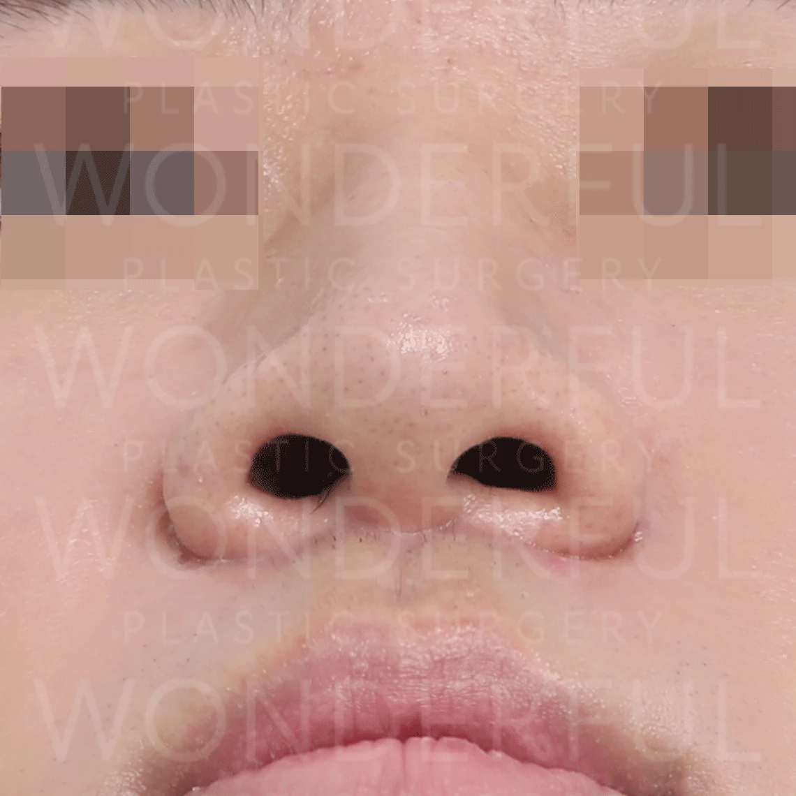 韩国精彩整形外科医院鼻孔鼻翼缩小手术前-后-结果-前-1