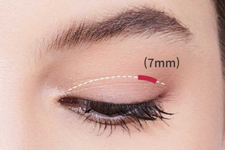 韩国美妙整形医院局部切开双眼皮手术方法步骤2