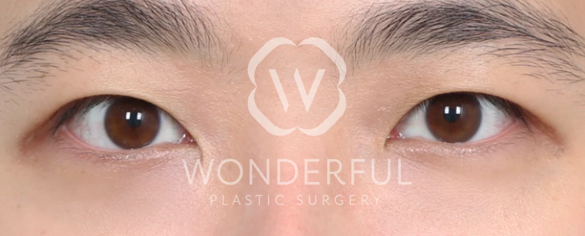 素晴らしい-整形外科-韓国の病院-眼瞼下垂矯正手術-前-後-結果-後-1