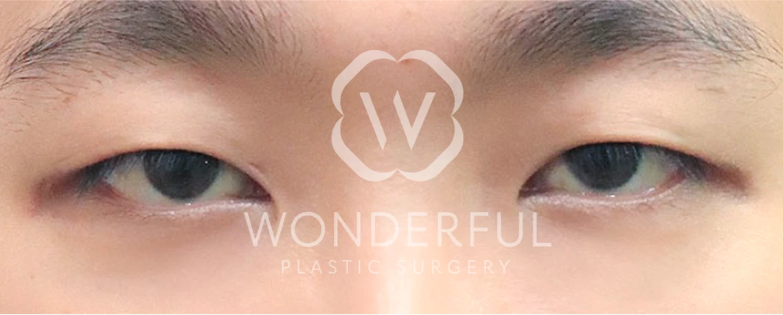 wonderful-plastic-surgery-hospital-in-korea-ptosis-correction-surgery-before-after-results-before-1