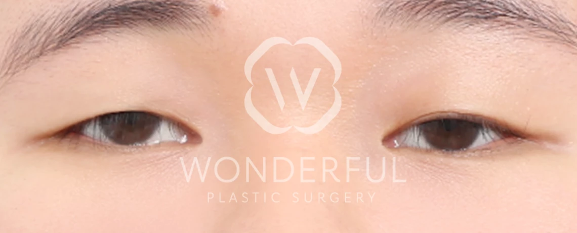 wonderful-plastic-surgery-hospital-in-korea-ptosis-correction-surgery-before-after-results-before-2