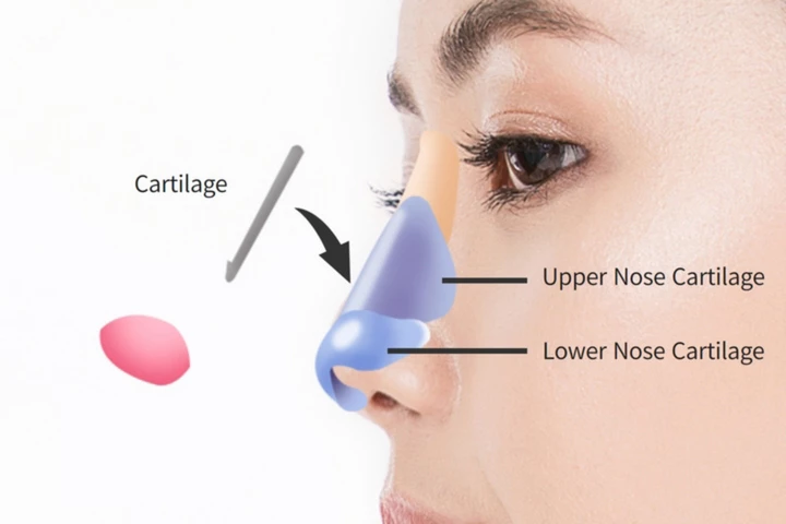 韓国の素晴らしい整形外科病院の短鼻手術方法ステップ2