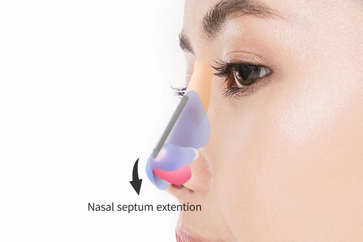 韓国の素晴らしい整形外科病院の短鼻手術方法ステップ3