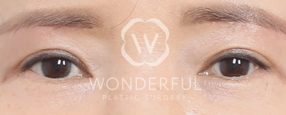 wonderful-plastic-surgery-hospital-in-korea-sub-brow-lifting-surgery-before-after-results-after-2