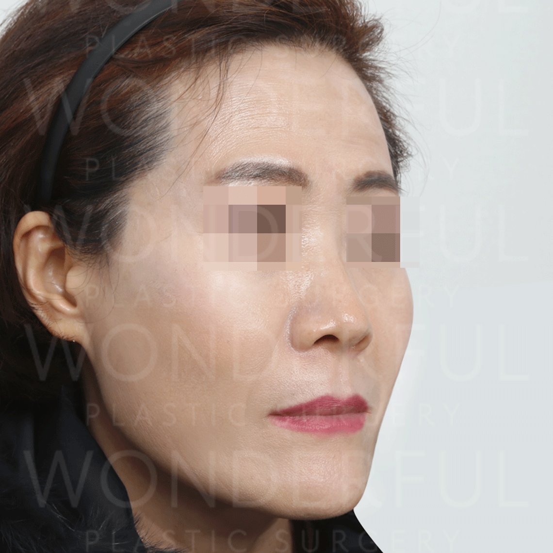 wonderful-plastic-surgery-hospital-in-korea-thread-lift-before-after-results-after-1