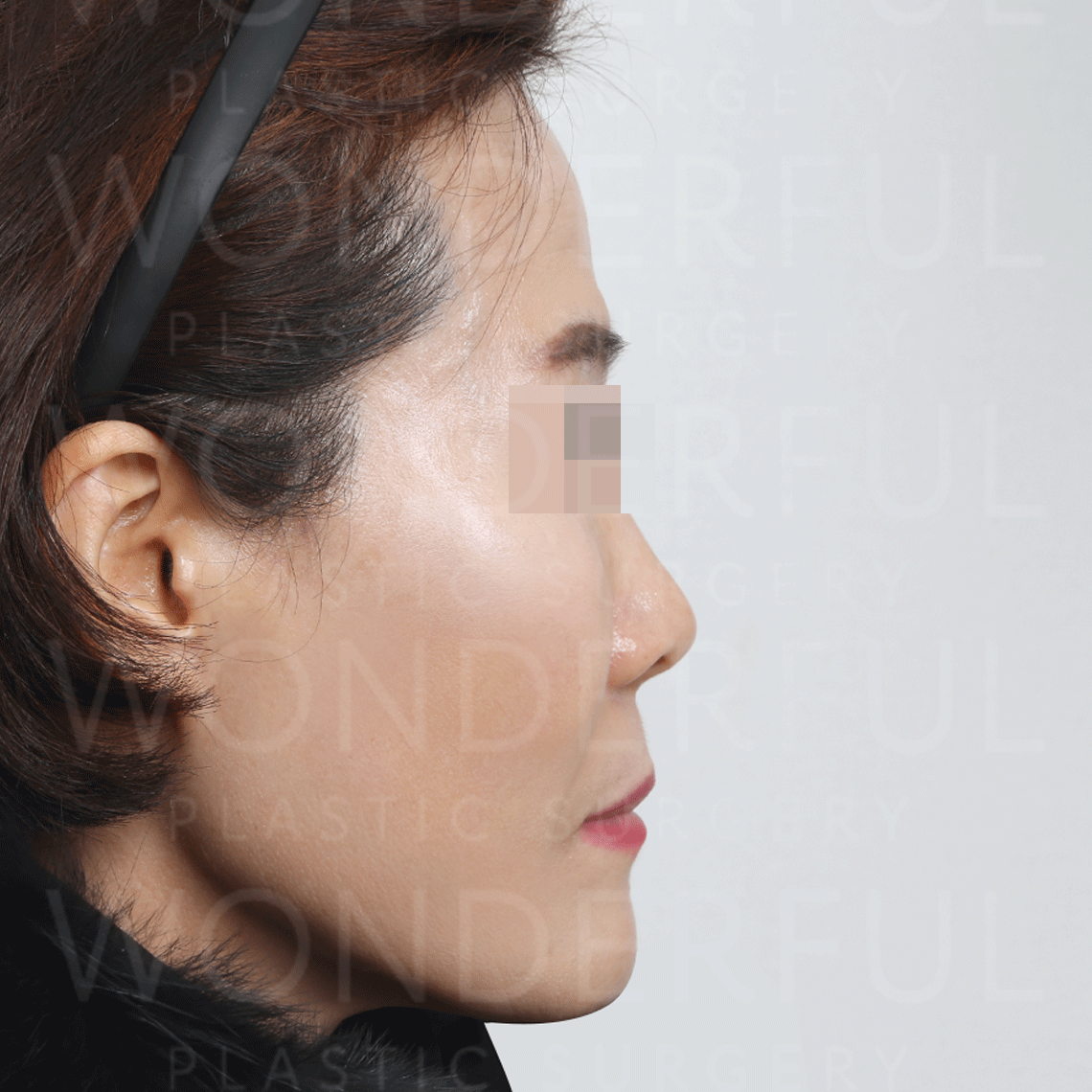 wonderful-plastic-surgery-hospital-in-korea-thread-lift-before-after-results-after-2