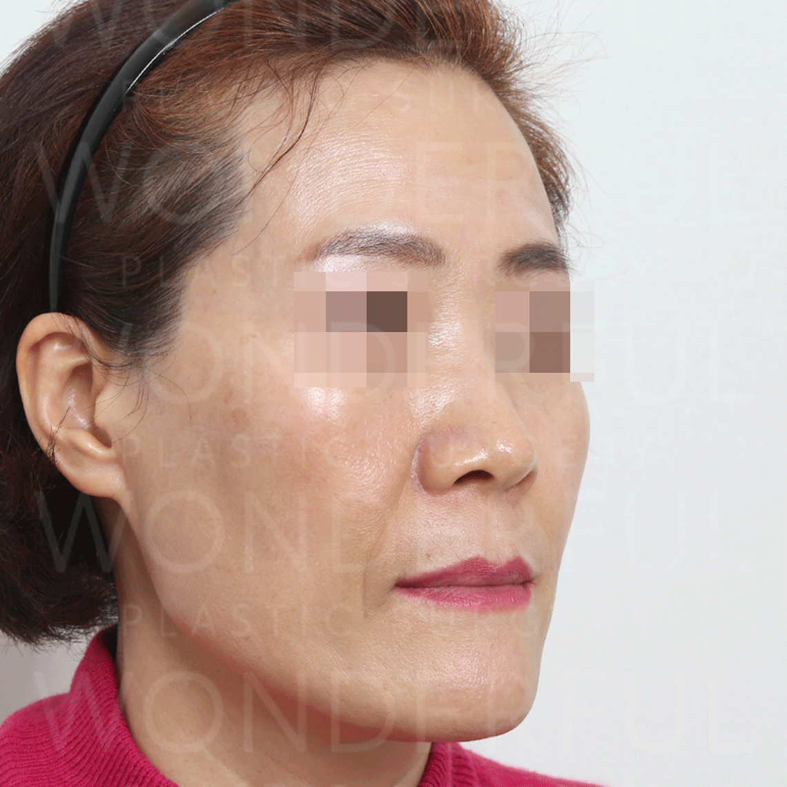 wonderful-plastic-surgery-hospital-in-korea-thread-lift-before-after-results-before-1