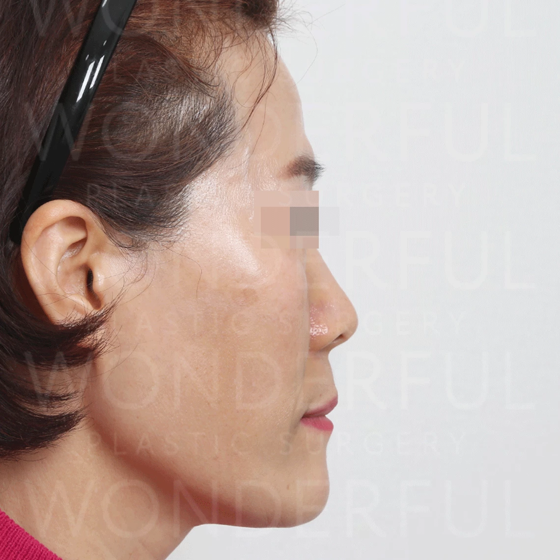 wonderful-plastic-surgery-hospital-in-korea-thread-lift-before-after-results-before-2