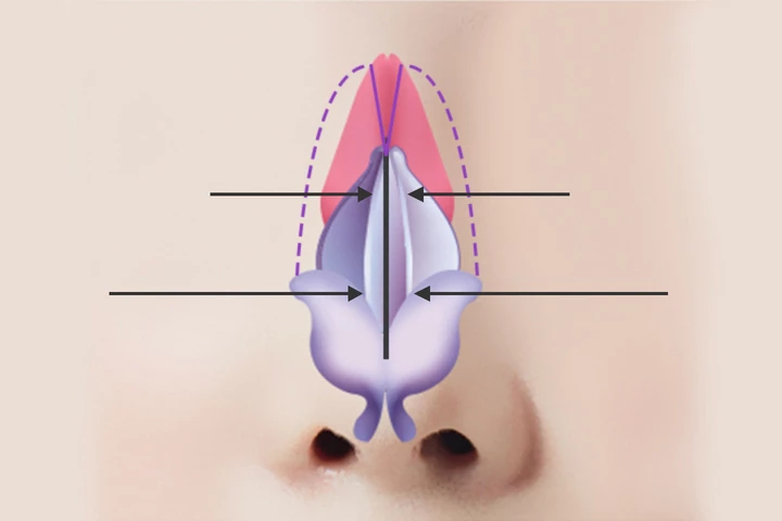 韓国の素晴らしい整形外科病院の広鼻手術方法ステップ2