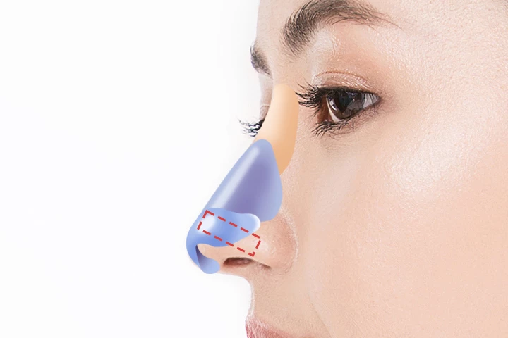 韓国の素晴らしい整形外科病院 素晴らしい矢鼻長い鼻の手術方法ステップ2