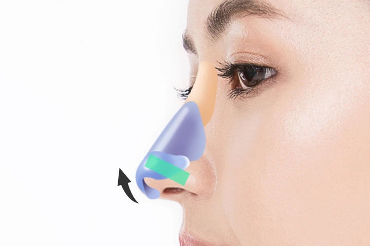 韓国の素晴らしい整形外科病院 素晴らしい矢鼻長い鼻の手術方法ステップ3