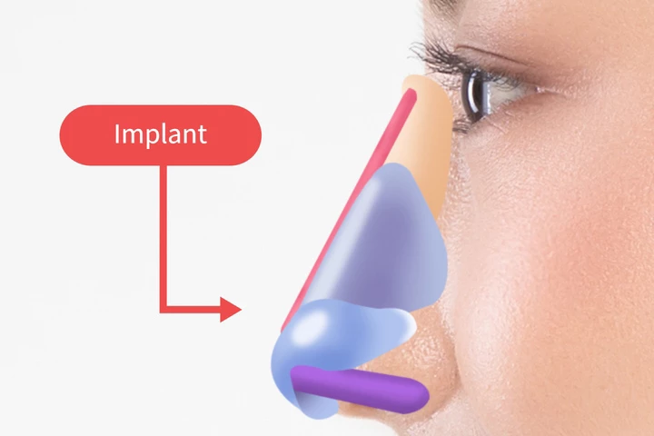 韓国の素晴らしい整形外科病院 素晴らしい鼻の鼻整形鼻橋インプラント