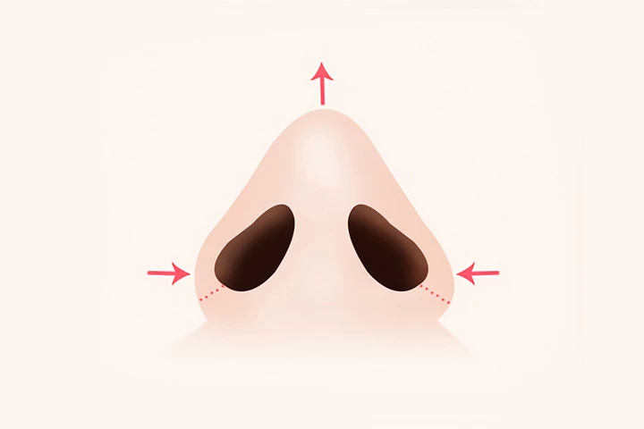 韓国の素晴らしい整形外科病院 素晴らしい鼻孔小鼻縮小手術方法 ステップ3
