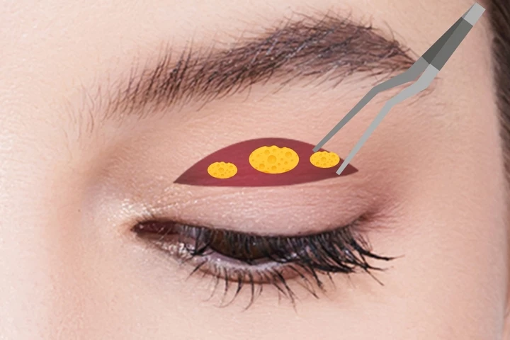 韩国美妙整形医院美妙优质切口双眼皮手术方法第3步