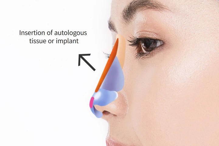 低い鼻の鼻整形手術の素晴らしい形成外科病院ステップ 3