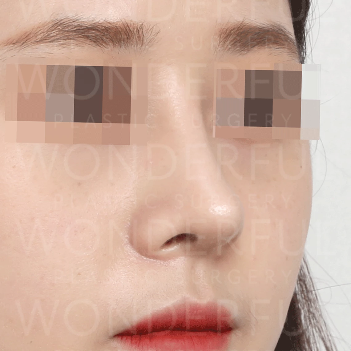 wonderful-plastic-surgery-hospital-korea-arrow-nose-rhinoplasty-before-after-results-after-1