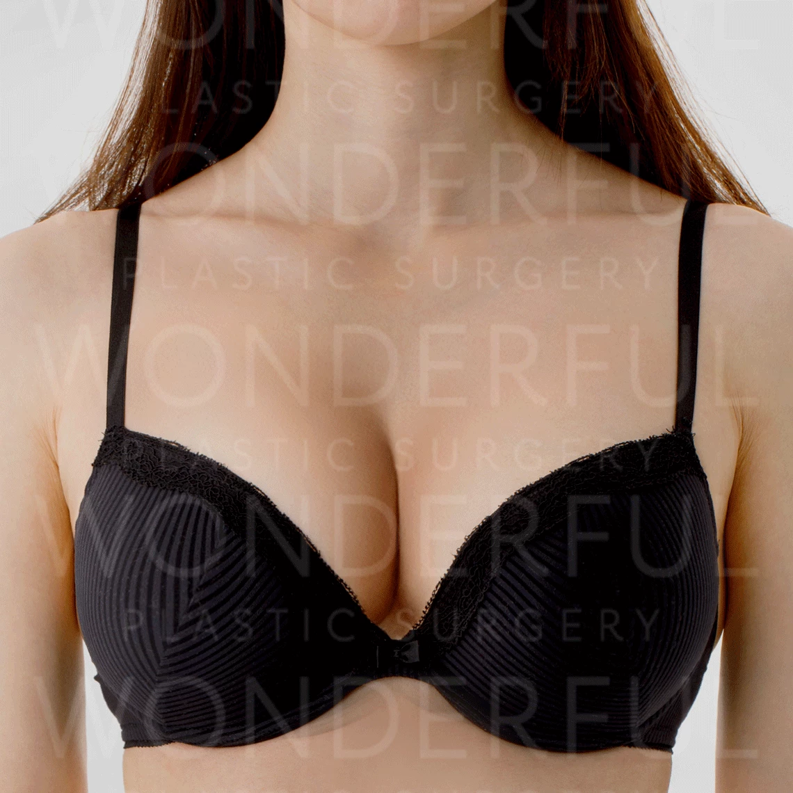 wonderful-plastic-surgery-hospital-korea-breast-augmentation-before-after-results-after-1