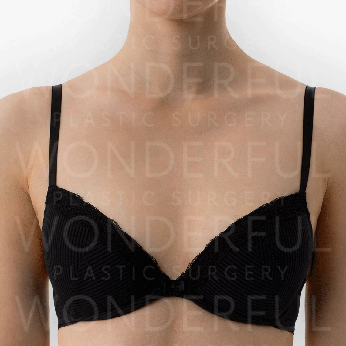 wonderful-plastic-surgery-hospital-korea-breast-augmentation-before-after-results-before-1