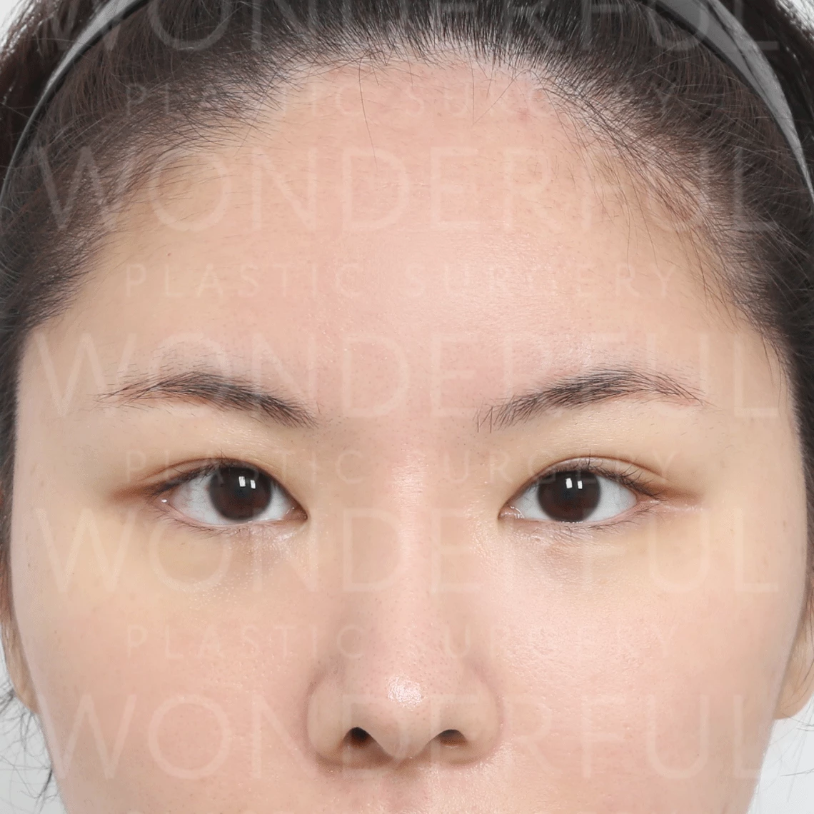wonderful-plastic-surgery-hospital-korea-endoscopic-fore-head-lift-surgery-before-after-results-before-1