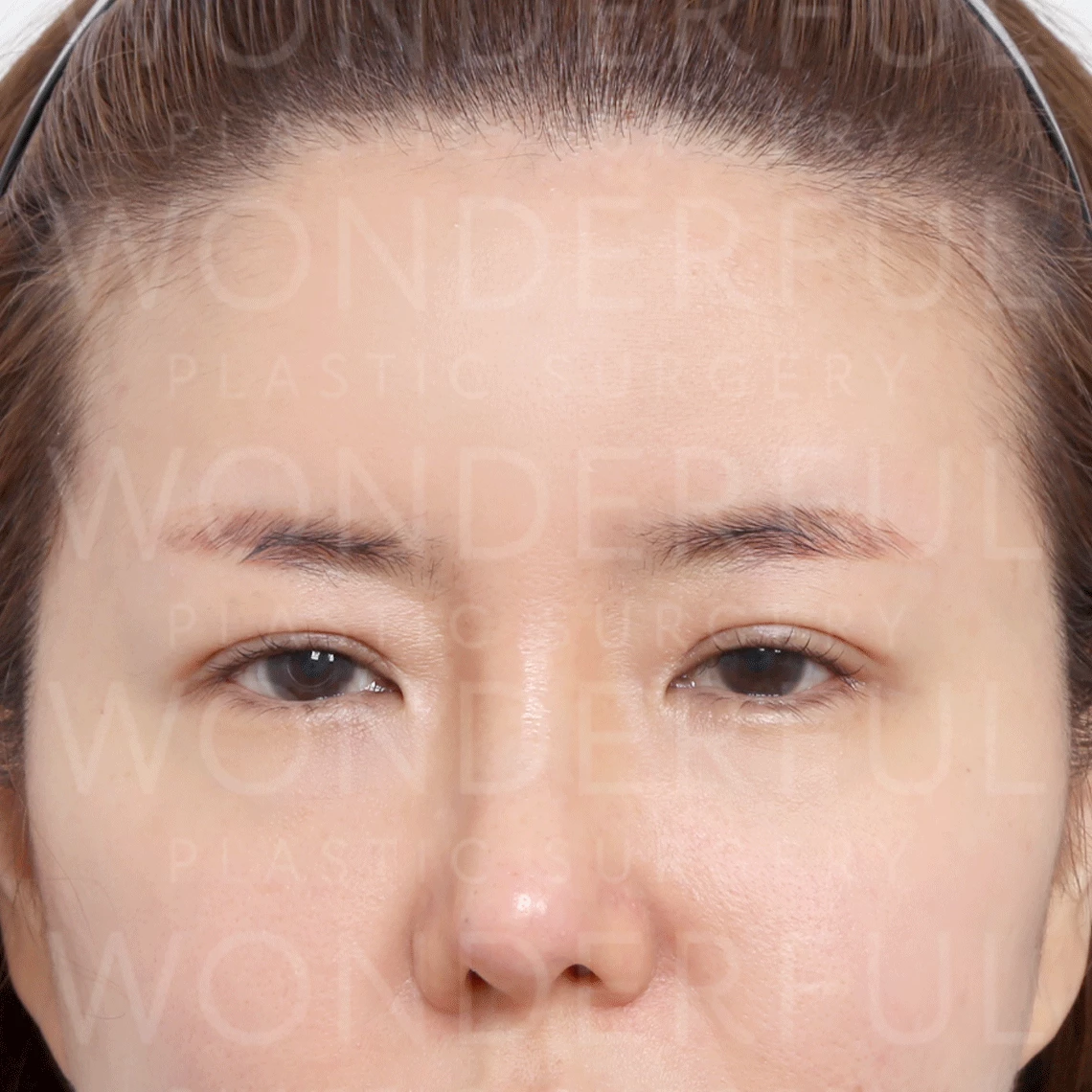 wonderful-plastic-surgery-hospital-korea-endoscopic-fore-head-lift-surgery-before-after-results-before-2