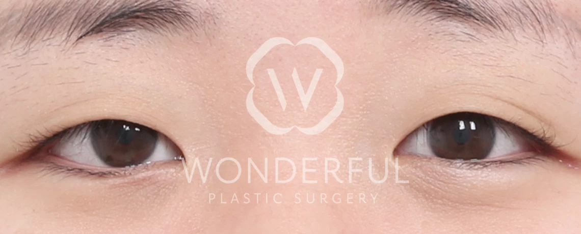 wonderful-plastic-surgery-hospital-korea-korean-partial-incision-double-eyelid-surgery-before-after-results-before-1