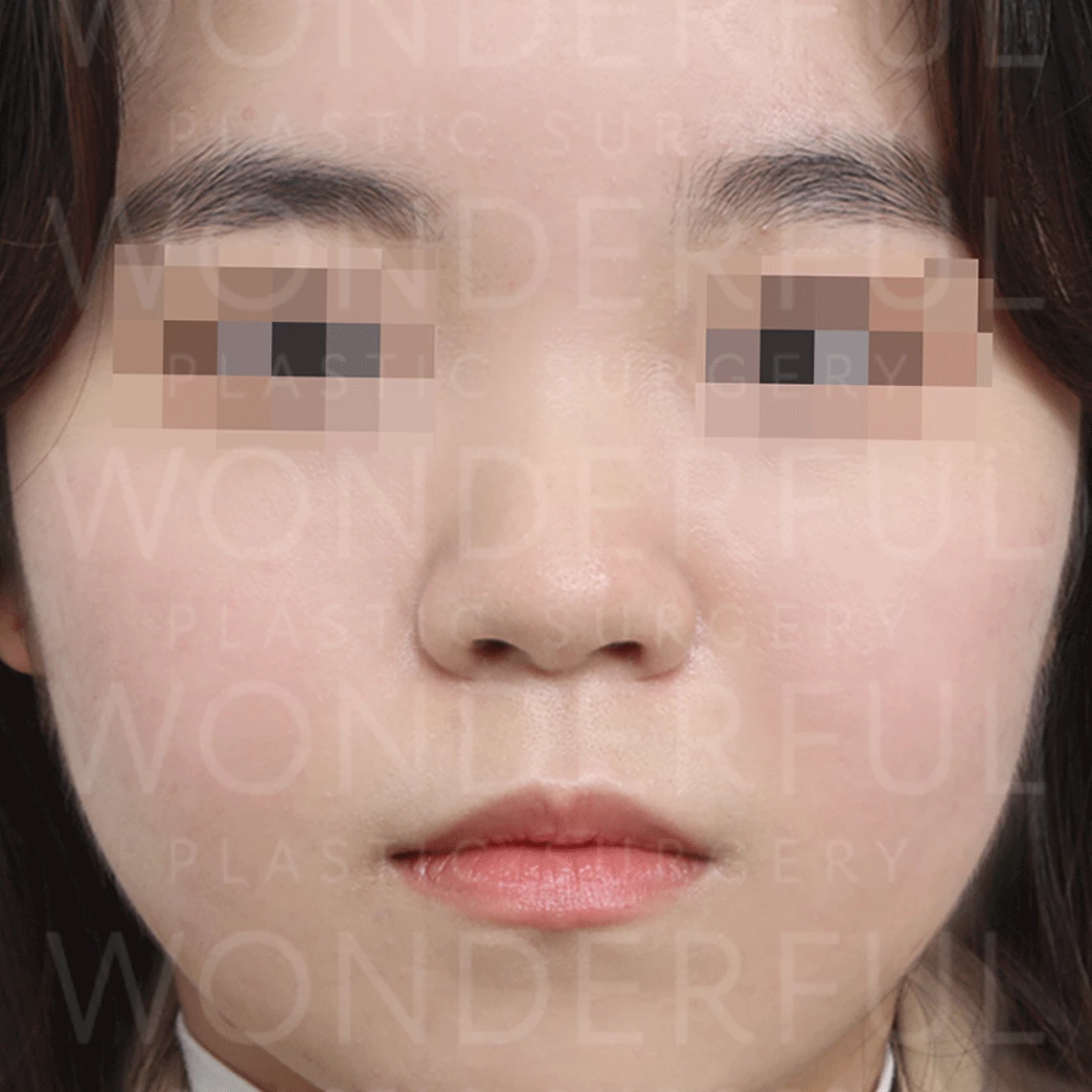 wonderful-plastic-surgery-hospital-korea-nose-rhinoplasty-before-after-results-before-1