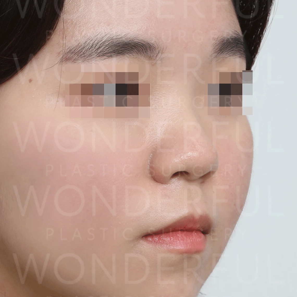wonderful-plastic-surgery-hospital-korea-nose-rhinoplasty-before-after-results-before-2