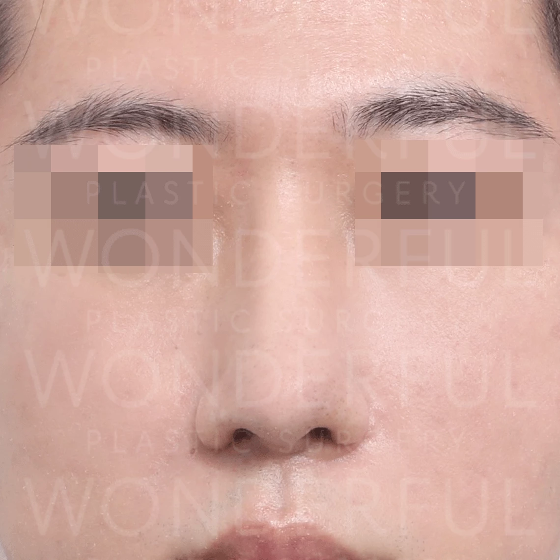 素晴らしい-整形手術-病院-韓国-広い鼻-鼻整形-ビフォーアフター結果-アフター1