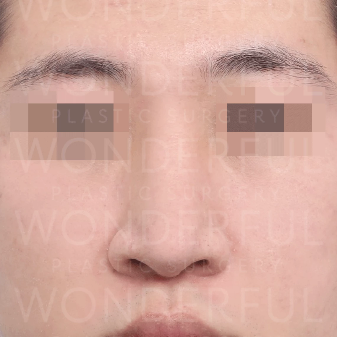 wonderful-plastic-surgery-hospital-korea-wide-nose-rhinoplasty-before-after-results-before-1